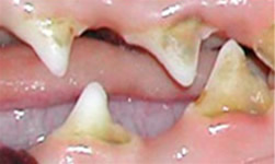 stage 2 dental disease